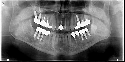 インプラント症例