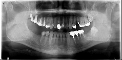 インプラント症例