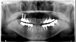 インプラント症例