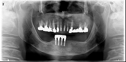 インプラント症例