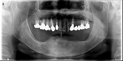 インプラント症例