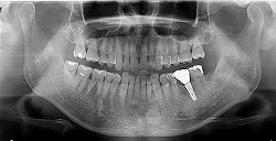 インプラント症例