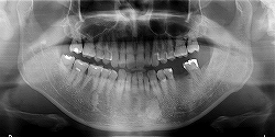 インプラント症例